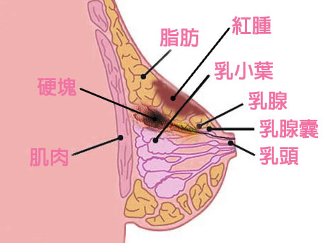 乳腺炎圖片