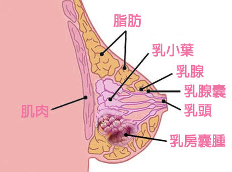 乳房囊腫圖片