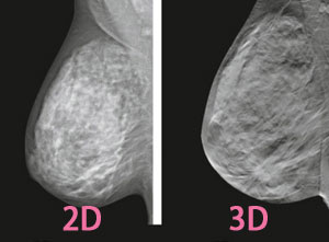 乳房X光造影檢查圖片2