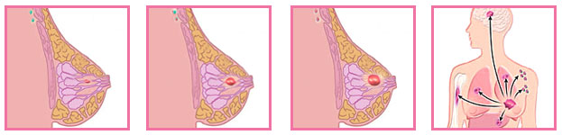 乳癌的一至四分期