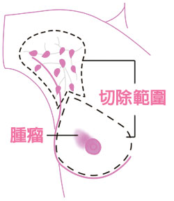 全乳房切除手術圖片